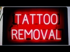Laser Tattoo Removal Palmerton PA Tattoo Removal