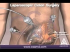 Colorectal Cancer Surgery India - Everything you need to know