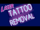 Laser Tattoo Removal Fenton MI PicoSure Tattoo Removal