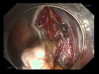 ESD Early Colon-rectal Cancer under Aohua Endoscopy System AQ-100
