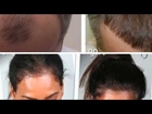 ovation hair - regrow hair - scalp med - Dr. Ari Arumugam - Cosmetic Surgery Chennai -