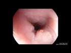 Squamous cell cancer esophagus (Squamous cell cancer)